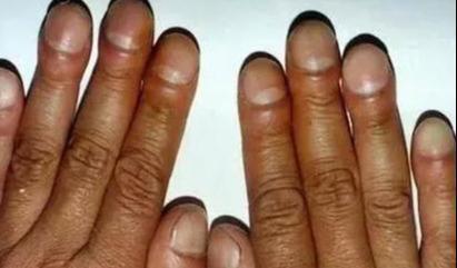 肺癌不是悄无声息,手上出现2种标记,最好查一下肺CT