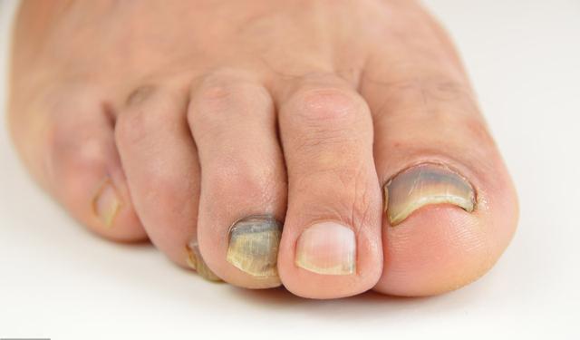 肺癌不是悄无声息,手上出现2种标记,最好查一下肺CT