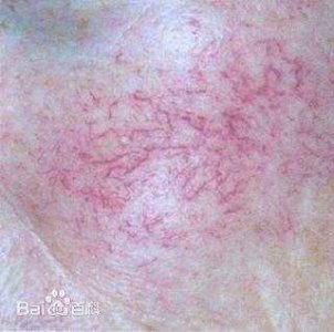 ​怎么样祛除红血丝最快