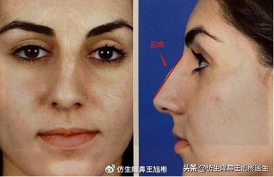 ​驼峰鼻是什么，需要矫正吗？