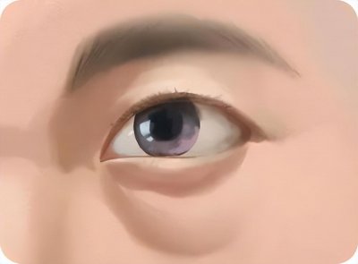 ​去眼袋黑眼圈 听说去眼袋可以解决黑眼圈，是真的吗？